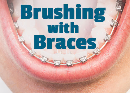Urbandale dentist, Dr. Stefanie Donnell-Randall of The Dental Loft informs patients about the best tools and tricks to use when performing oral hygiene routines with braces.