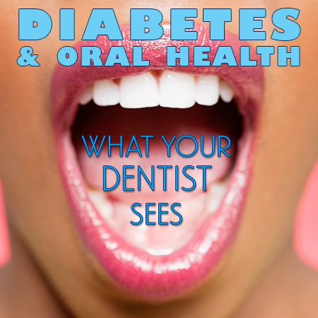 Urbandale dentists, Dr. Stefanie Donnell-Randall of The Dental Loft, discuss the side effects of diabetes and how it affects your oral health.