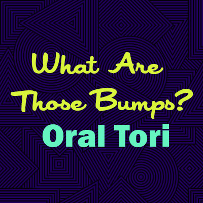 Urbandale dentist, Dr. Stefanie Donnell-Randall at The Dental Loft explains oral tori—what they are, why they happen, and whether they are a cause for concern.